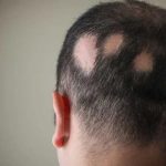 علت ریزش مو سکه ای چیست؟ راه های درمان آن