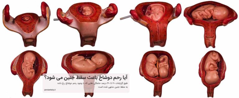 آیا رحم دوشاخ در بارداری خطرناک است