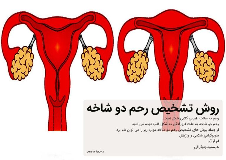 رحم دوشاخ چیست و چه عوارضی به همراه دارد