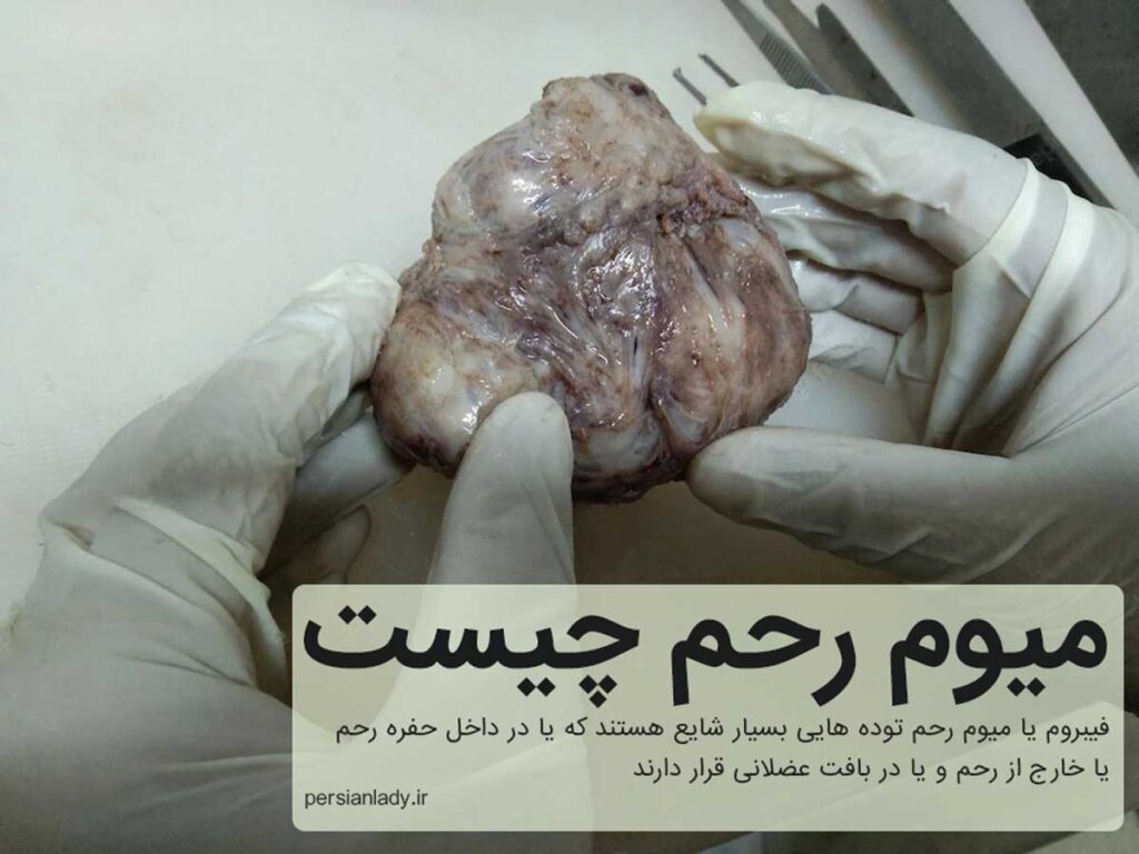 میوم رحم چیست