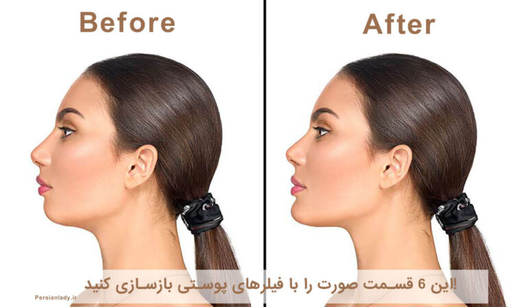 این ۶ قسمت صورت را با فیلرهای پوستی بازسازی کنید!