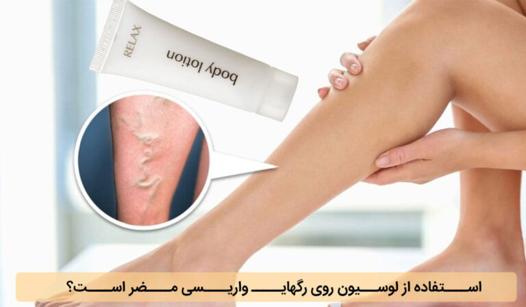 استفاده از لوسیون روی رگهای واریسی مضر است؟