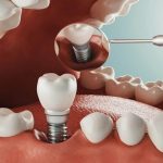 عوارض خطرناک کاشت ایمپلنت دندان