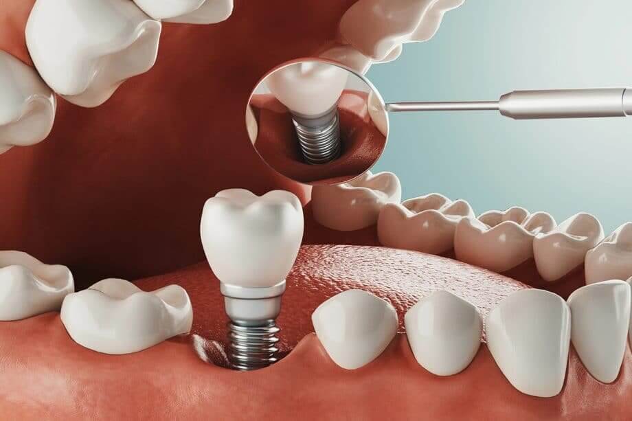 عوارض خطرناک کاشت ایمپلنت دندان