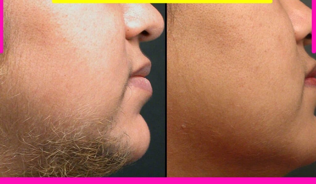 دستگاه لیزر بدن موهای سفید و جوگندمی