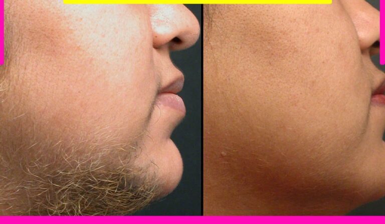 دستگاه لیزر بدن موهای سفید و جوگندمی تفاوت دارند؟