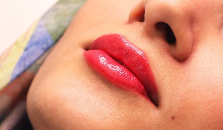 نکاتی که باید قبل از تزریق ژل لب روسی بدانید