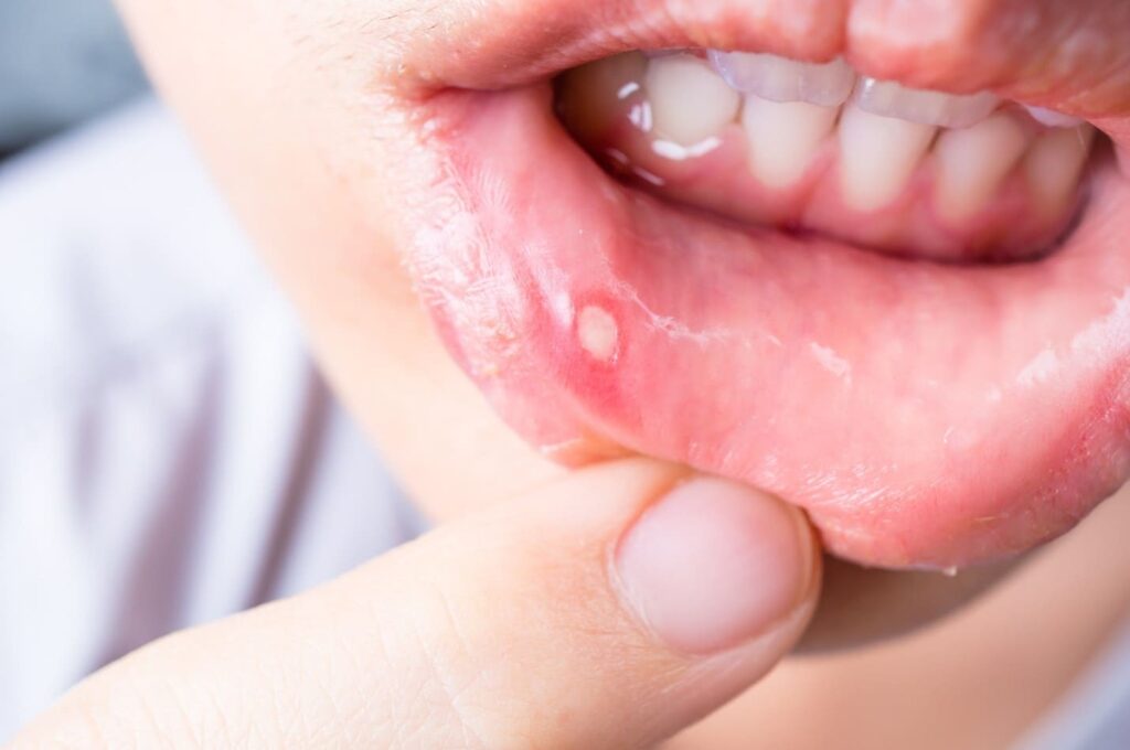 راه‌های مقابله با آفت دهان چیست و چگونه درمان می شود؟