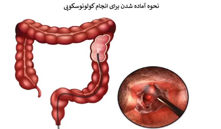 قبل از کولونوسکوپی چه کنیم و چه بخوریم؟