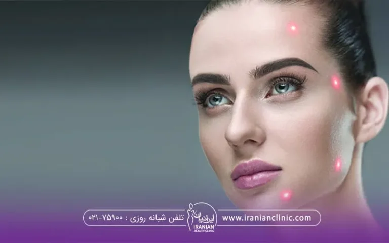 کاربردهای اندولیفت در جوانسازی صورت چیست؟