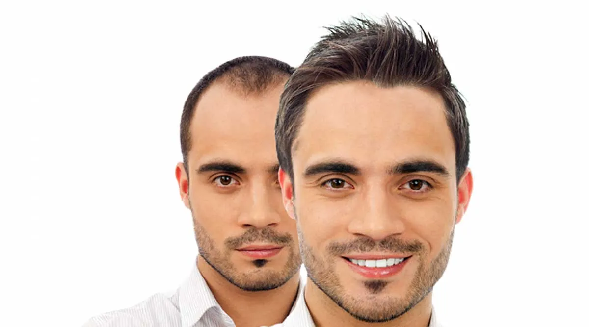 جدیدترین تکنولوژی کاشت مو در ایران چیست؟ مقایسه روشهای FUE،DHI و SUT به زبان ساده کاشت مو