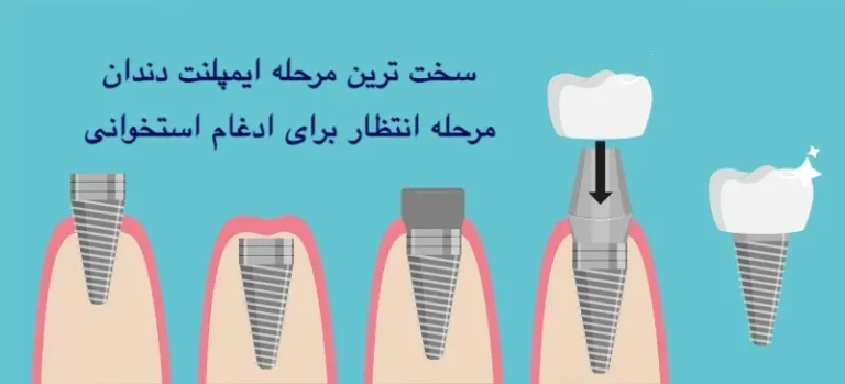 سخت ترین مرحله ایمپلنت دندان کدام است؟
