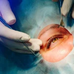 همه چیز درباره بهترین و جدیدترین عمل برای مشکلات چشم + مقایسه با روشهای قدیمی جدیدترین عکل برای مشکلات چشم