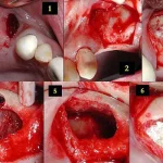 جراحی لیفت سینوس ( Sinus Lift ) چیست؟ | هزینه + مراحل جراحی لیفت سینوس ( Sinus Lift ) چیست؟ | هزینه + مراحل
