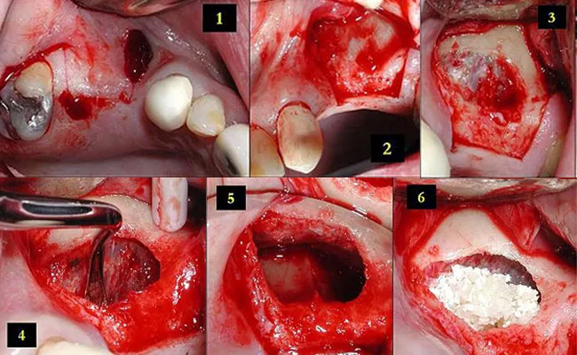 جراحی لیفت سینوس ( Sinus Lift ) چیست؟ | هزینه + مراحل