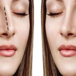 بهترین سن برای عمل بینی و تاثیر آن بر نتیجه نهایی کدومه؟