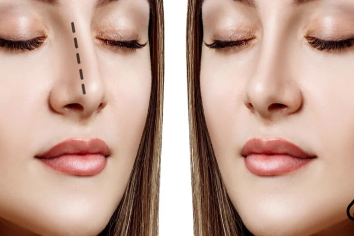 بهترین سن عمل بینی و تاثیر آن بر نتیجه نهایی