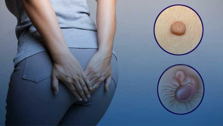 10 نکته که باید درباره زگیل مقعدی بدانید درمان زگیل مقعدی