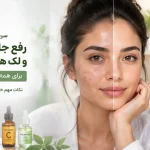 سریع‌ترین روش درمان جای جوش | معرفی بهترین روش ها و محصولات