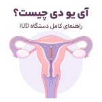 آی یو دی چیست؟ نحوه گذاشتن، عوارض و مراقبت‌های بعد از IUD