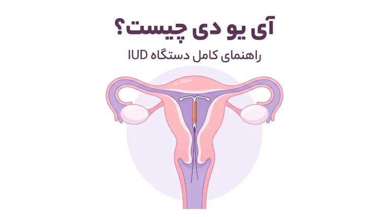 آی یو دی چیست؟ راهنمای کامل دستگاه IUD، نحوه گذاشتن، عوارض و مراقبت‌ها