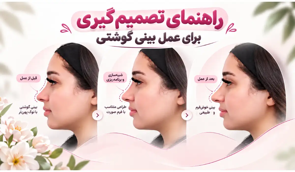 از عکس قبل و بعد تا جلسه مشاوره؛ راهنمای تصمیمگیری برای عمل بینی گوشتی از عکس قبل و بعد تا جلسه مشاوره؛ راهنمای تصمیمگیری برای عمل بینی گوشتی